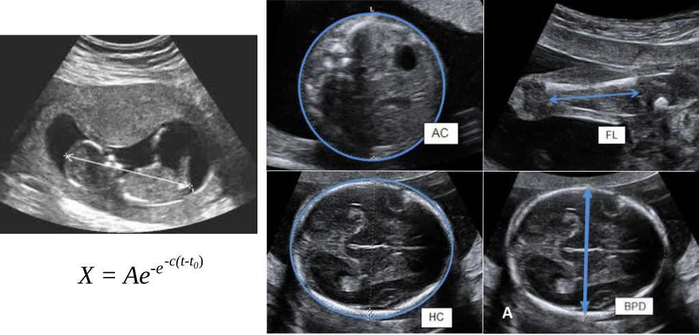 A new model reveals the weight of a newborn from routine pregnancy scans